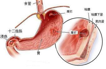 胃炎患者健康路上注意五点