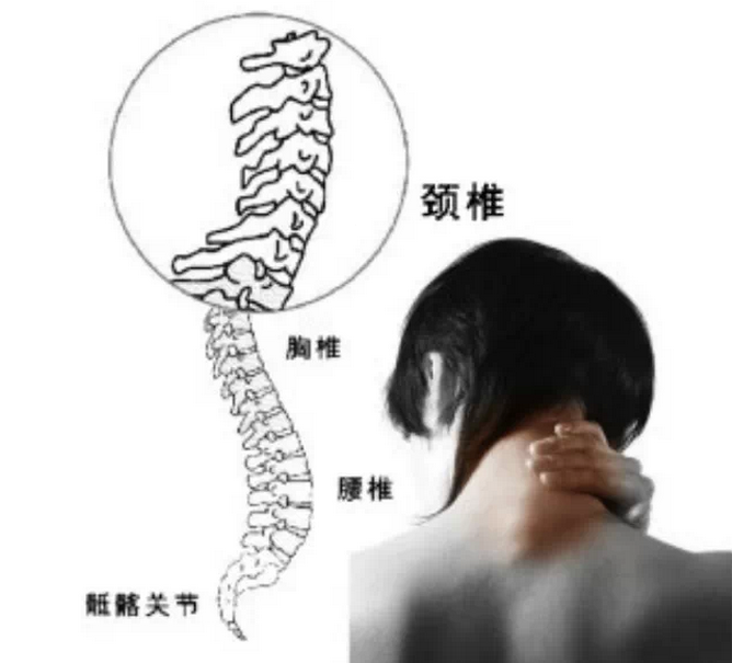 颈椎病引起两种头痛头晕?