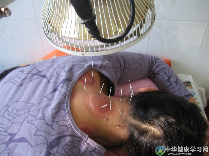 中医治疗颈椎病?