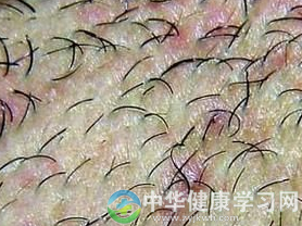 什么是外阴毛囊炎?如何防治外阴毛囊炎?