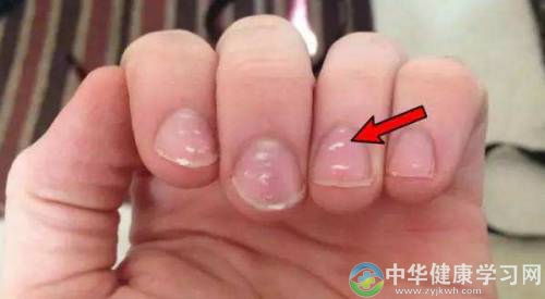 宝宝指甲有倒刺、白色斑点，怎么回事你知道吗？